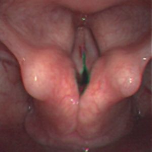 The Larynx