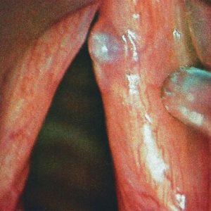 Polyp Cordal