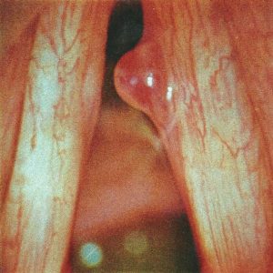 Telangiectatic polyp