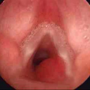 Angioma Subglótico
