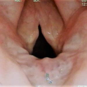 Edema of Reinke
