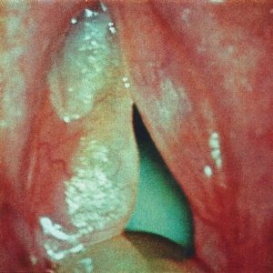 Edema de Reinke