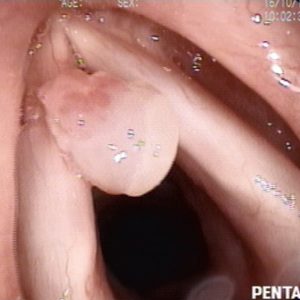 Papiloma