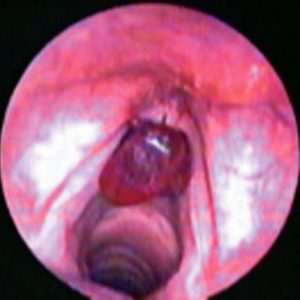 Hematoma Cordal