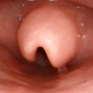 Epiglotitis