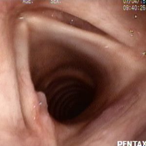 Granuloma Cordal