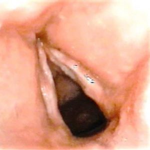 Surcus Vocalis