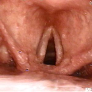 Moniliasis Laríngea