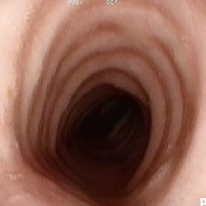 Normal Trachea