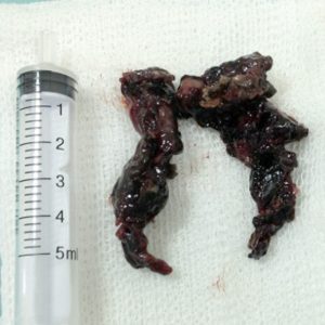 Coagulo Pétreo