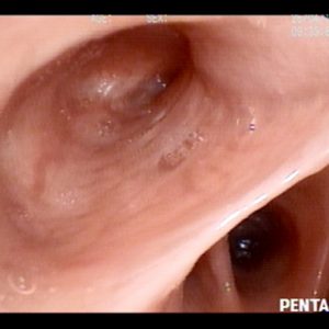 The middle lobe syndrome