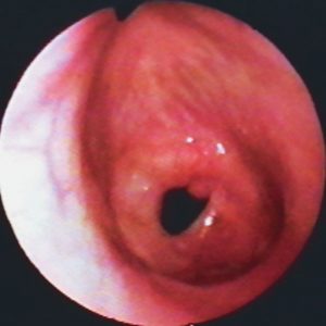 Estenosis Subglótica