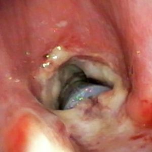 Stents y estenosis