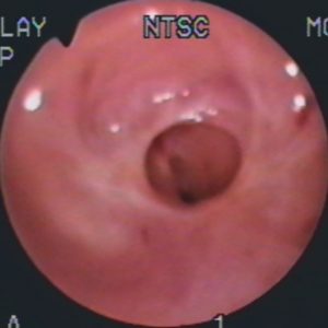 Estenosis Traqueal Benigna