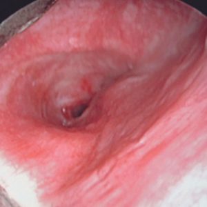 Estenosis Bronquial