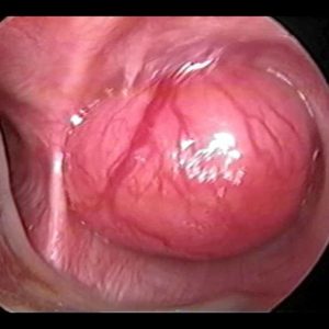 Tumor Bronquial Miofibroblástico