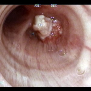 Tumor Bronquial
