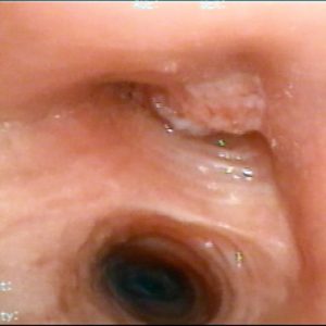 Carcinoma Bronquial