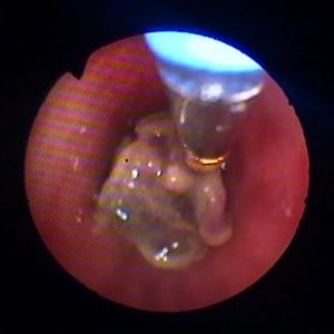 Criobiopsia Bronquial