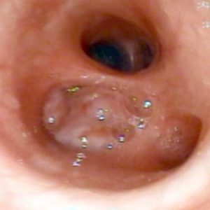 Carcinoma Bronquial