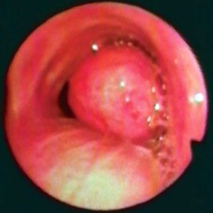 Adenoma Bronquial