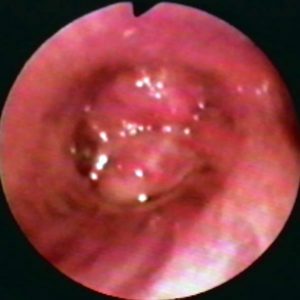 Adenoma Bronquial