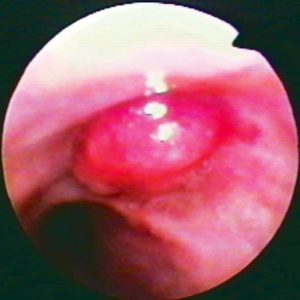 Adenoma Bronquial