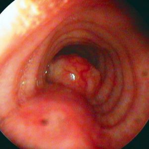 Carcinoma Adenoide Quístico