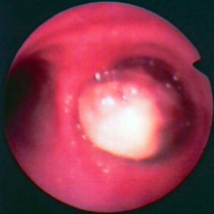 Carcinoma Bronquial