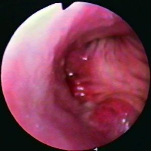 Carcinoma Bronquial