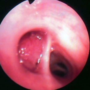 Adenocarcinoma Bronquial