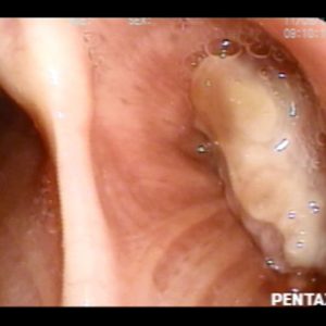 Tumor Bronquial
