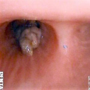 Tumor Bronquial