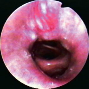 Carcinoma Bronquial