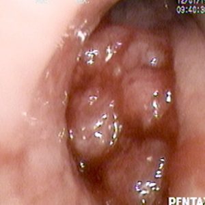 Carcinoma Bronquial