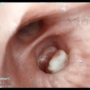 Carcinoma Bronquial