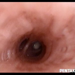 Tumor Bronquial