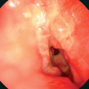 Tumor Bronquial Intramural