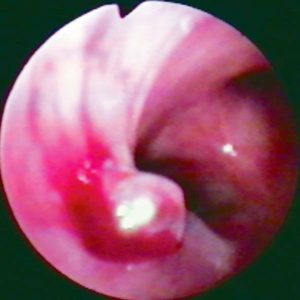 Carcinoma Bronquial