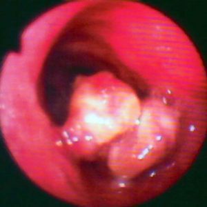 Tumor Traqueal