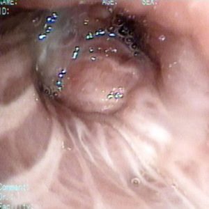 Tumor Bronquial