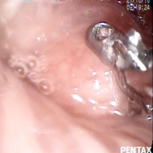 Tumor Bronquial
