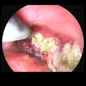 Radiofrecuencia. Tumor Traqueal