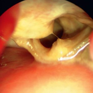 Carcinoma Traqueal