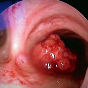 Carcinoma Bronquial Epidermoide