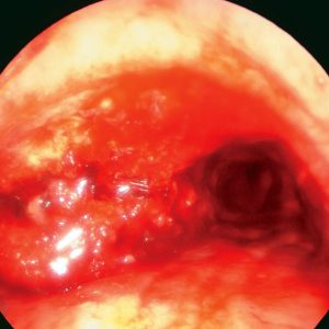 Tracheal Carcinoma