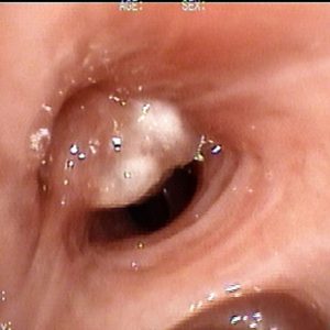 Tumor Bronquial
