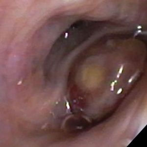 Metástasis Bronquial. Carcinoma Renal
