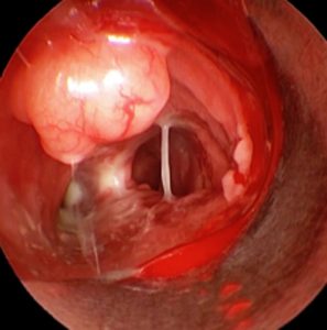 Metástasis Traqueal. Carcinoma de Mama