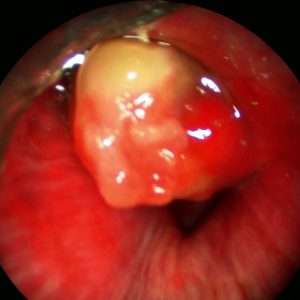 Metástasis Bronquial. Carcinoma de Células Claras